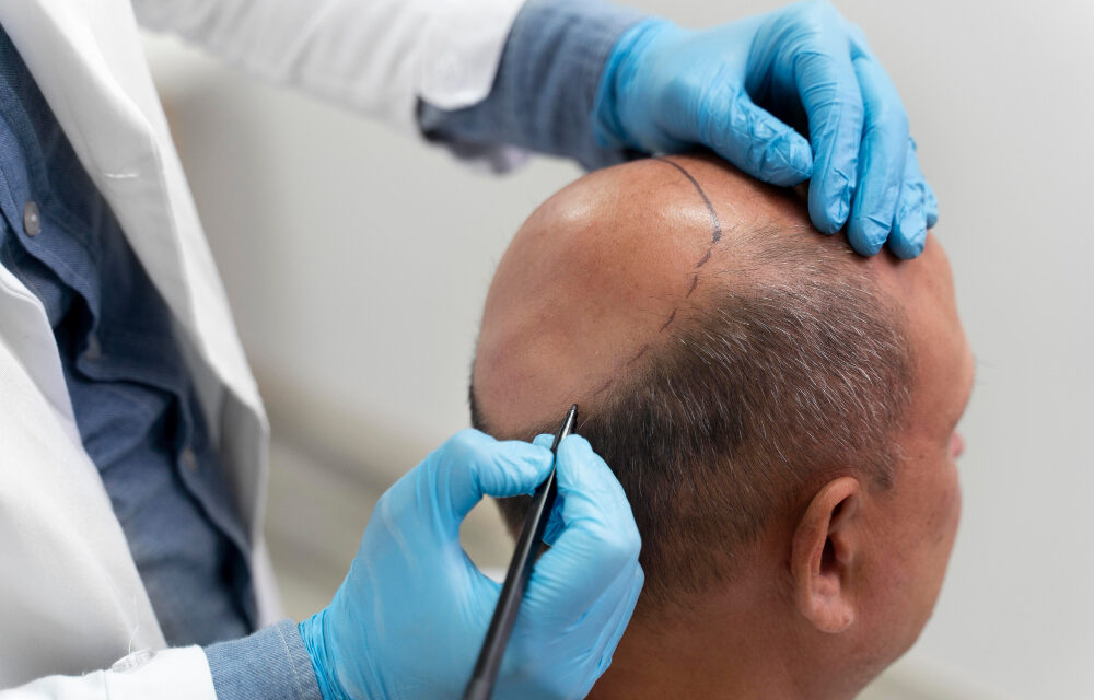 Hair Transplant- A Guide and Aesthetics to Keep in Mind