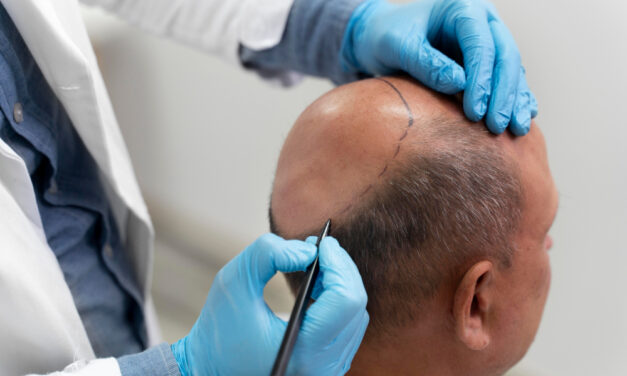 Hair Transplant- A Guide and Aesthetics to Keep in Mind